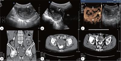 Challenges of Diagnosing Primary Ewing’s Sarcoma in the Small Intestine of the Elderly: A Case Report